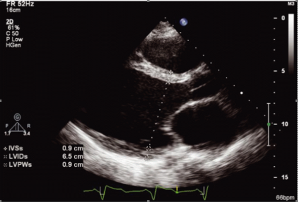 Stress Echocardiogram – Sydney North Cardiology